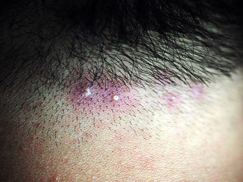 All About Ingrown Hairs